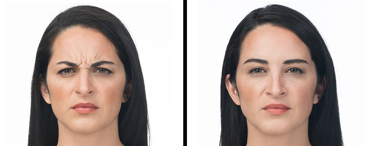 All images are accredited to BOTOX® Cosmetic an Allergan Aesthetics product