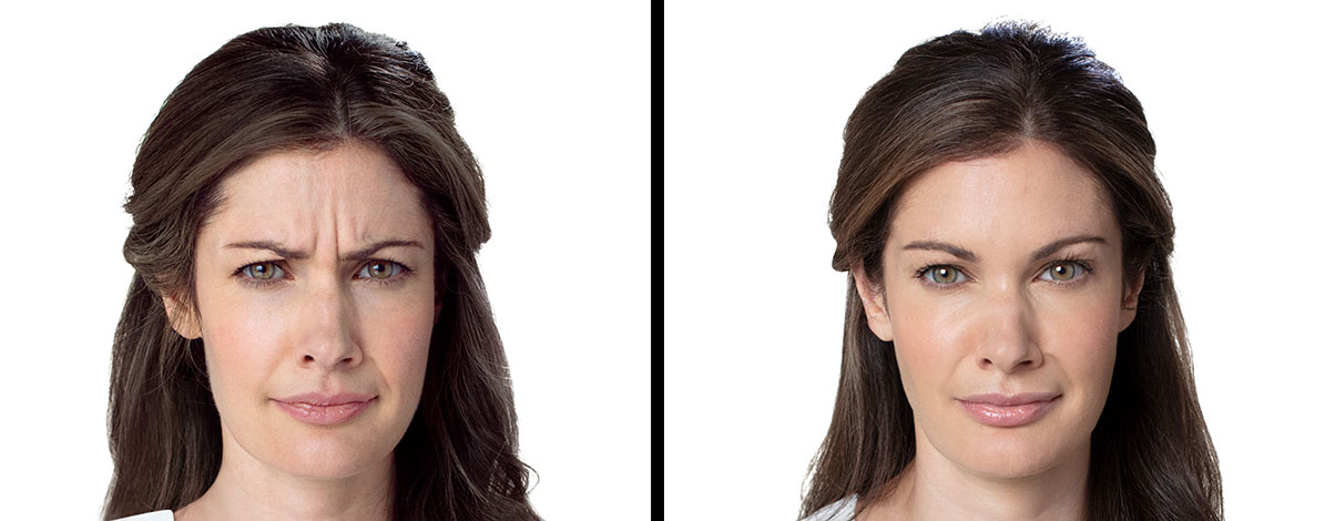 All images are accredited to BOTOX® Cosmetic an Allergan Aesthetics product