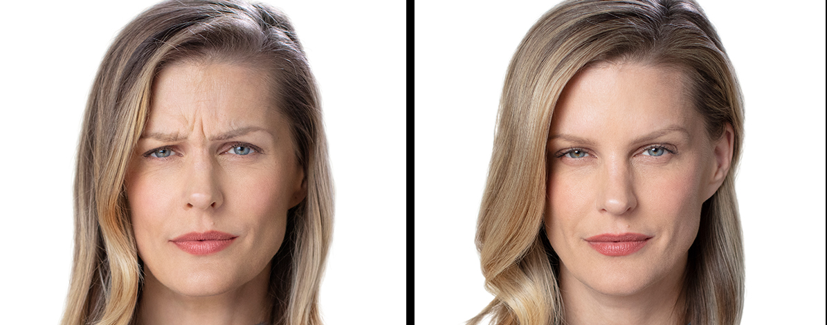 All images are accredited to BOTOX® Cosmetic an Allergan Aesthetics product
