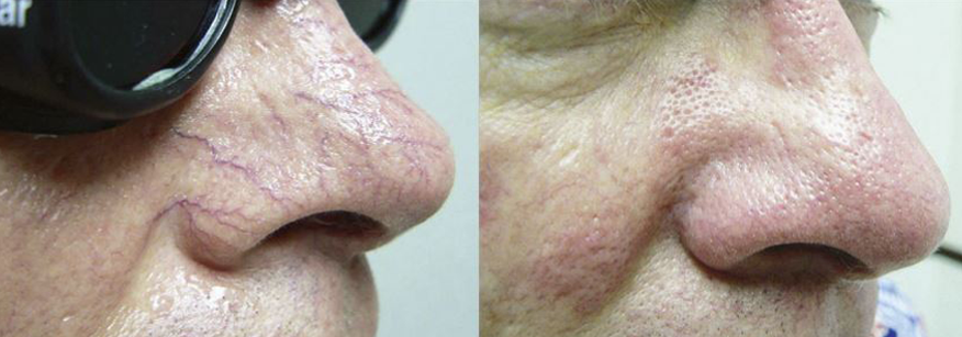 Facial vein