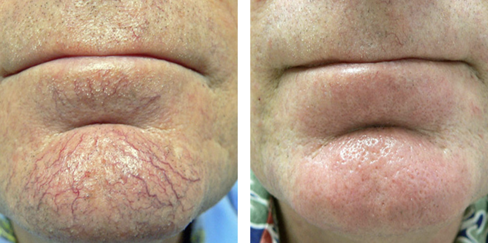 Facial vein2